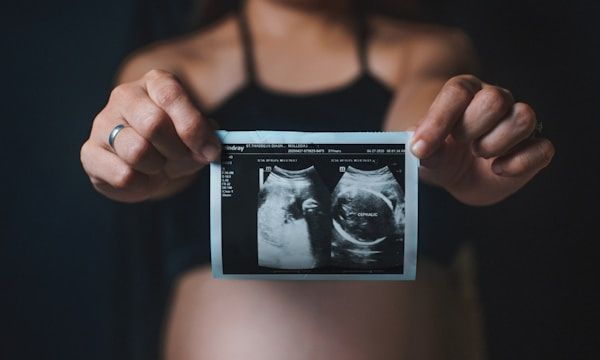 2D black-and-white baby ultrasound scan print